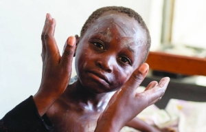 Africa could start mpox vaccinations within days